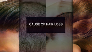 6 CAUSES OF HAIR LOSS