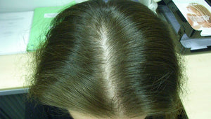 #1 Success Story: ReHair® Laser Cap Treatment Helps Charlotte Reverse Hair Loss